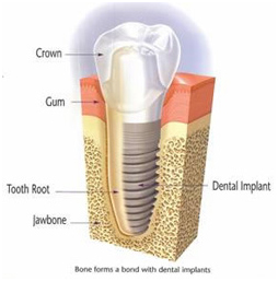illustration of implant