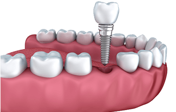single-tooth-implant