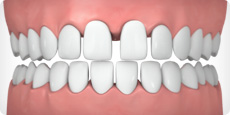 widely-spaced-teeth